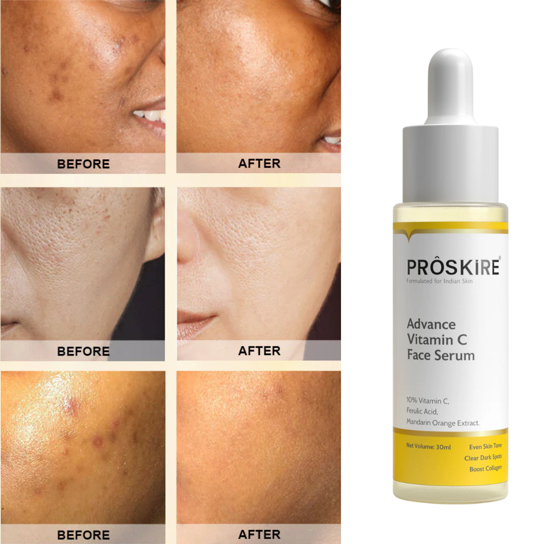 Proskire 10% Vitamin C Face serum | Reduces Dark Spots, Uneven Skin Tone (Pack of 2)