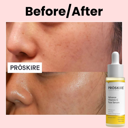 Proskire 10% Vitamin C Face serum | Reduces Dark Spots, Uneven Skin Tone (Pack of 2)